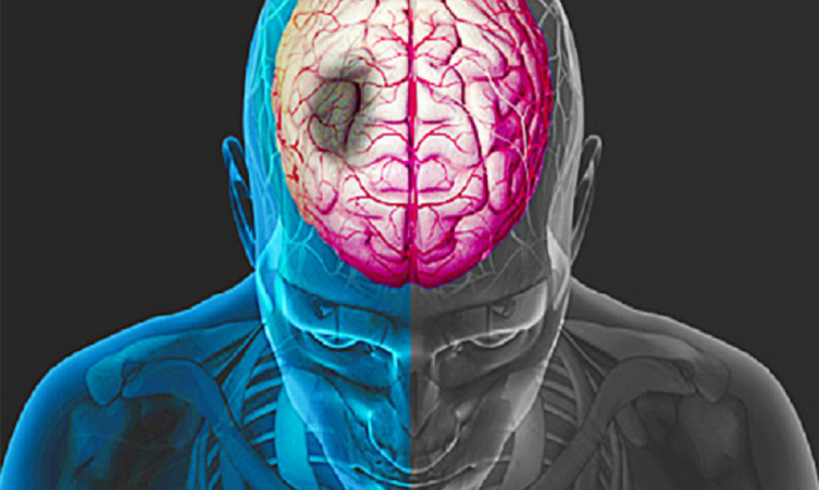 Prevención del accidente cerebro vascular (ACV) - Imagen ilustrativa