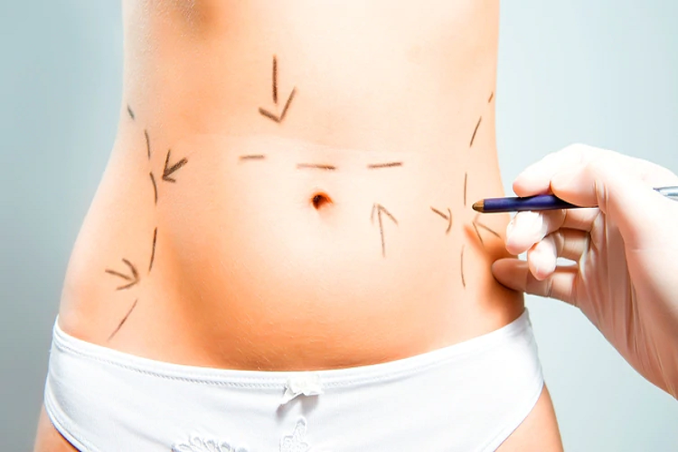 La abdominoplastía es el procedimiento ideal para reducir drásticamente el aspecto 