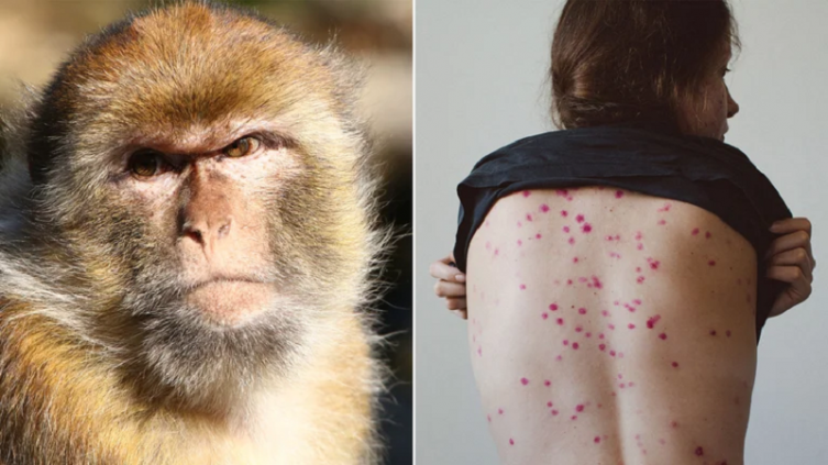 Entre España, Portugal, el Reino Unido y Estados Unidos, se cuentan más de 45 casos, entre sospechosos y confirmados, de viruela del mono (Getty Images)