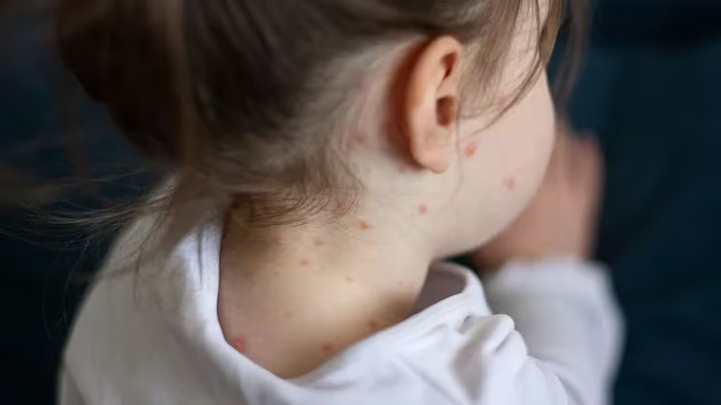 Confirman en Salta un caso de sarampión en un bebé de 19 meses: cuáles son los síntomas (Gettyimages)